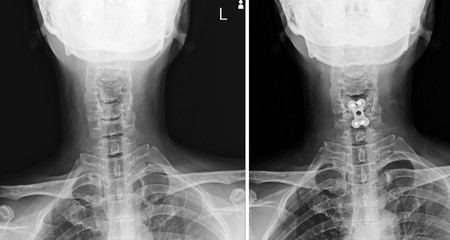 X-ray C-SPINES show post operation internal fixation C4-C5 & C6 with plate & screws red mark and...