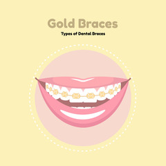Gold Dental Braces. Types of Dental Braces. Vector flat illustration of smile with braces on the teeth.