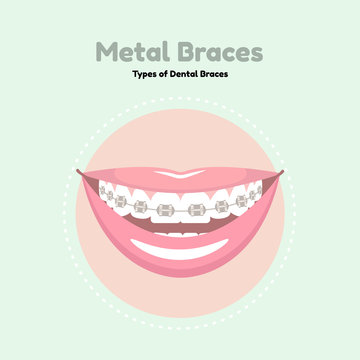 Metal Dental Braces. Types of Dental Braces. Vector flat illustration of smile with braces on the teeth.