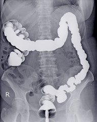 Special examination Barium enema A Female 61 year old.