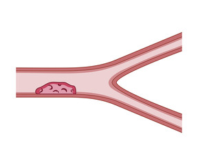 Thrombosis Blood Vessel