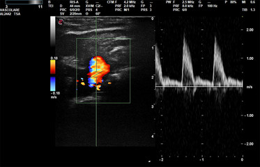 Ecodoppler ultrasound imaging diagnostic video screen