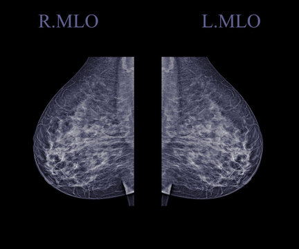  X-ray Digital Mammogram  or mammography  both side of the breast  MLO view  for finding Breast cancer in women . Clipping path.