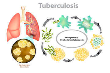 Tuberculosis (TB). Progression of pulmonary tuberculosis - Mycobacterium tuberculosis (MTB) bacteria