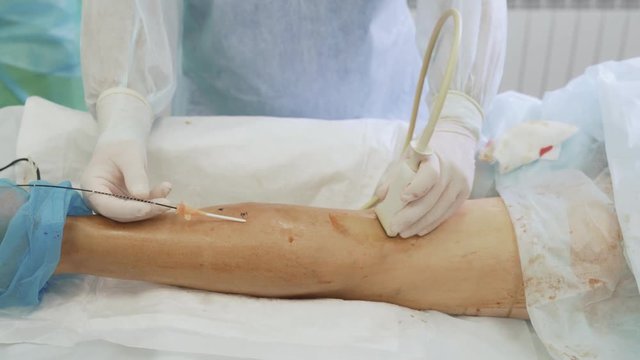 Close up phlebologist introduces special instrument in patient leg and makes ultrasound during operation