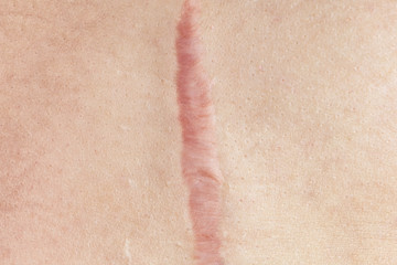 Close up of cyanotic keloid scar caused by surgery and suturing, skin imperfections or defects. Hypertrophic Scar on skin, dermatology and cosmetology concept - obrazy, fototapety, plakaty
