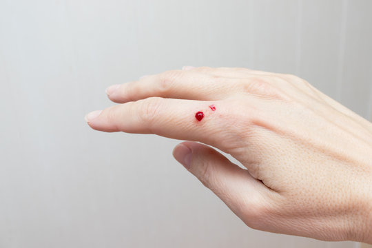 A bloody wound on female hand close up, skin damage, injury