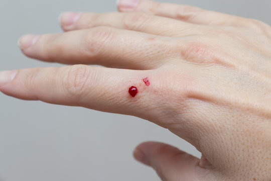 A bloody wound on female hand close up, skin damage, injury