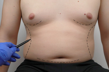 Tummy tuck, liposuction, breast surgery. A plastic surgeon prepares a man for plastic surgery.