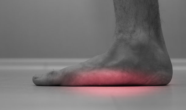 Flat feet (pes planus or fallen arches). close up of flat men foot. 