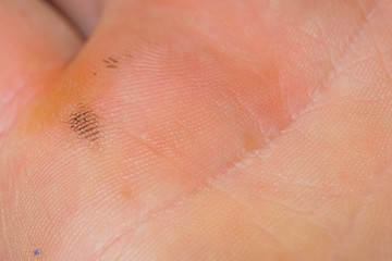 The texture of the skin of the palms. Papilloma virus on hands in the initial stage. Life lines on...