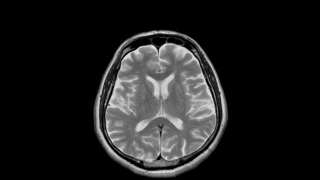 Layered MRI brain scan, looped