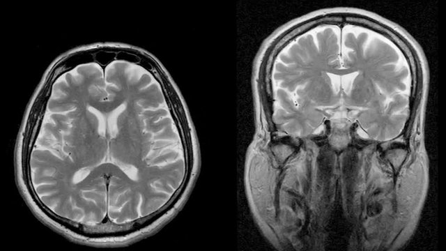 Magnetic resonance scan of the head top and front, MRI, looped