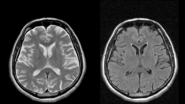 Magnetic resonance scan of the headache in two different ways, MRI, looped