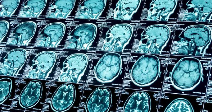 MRI scans in eight rows are moving diagonally, looped