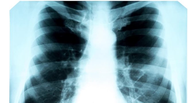 X-ray of the chest on the light screen