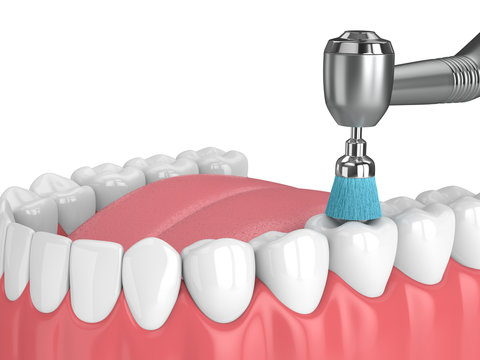 3d render of jaw with dental handpiece and polishing brush