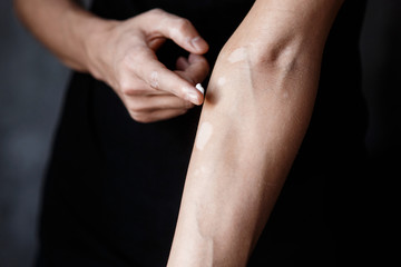 vitiligo close-up well hands on a black background