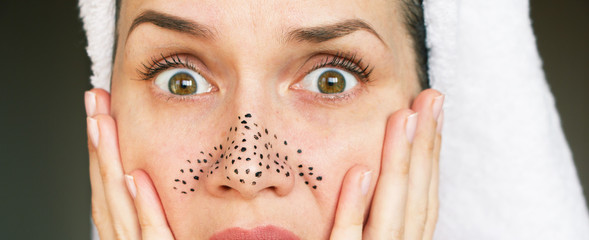 girl with acne and pores on face