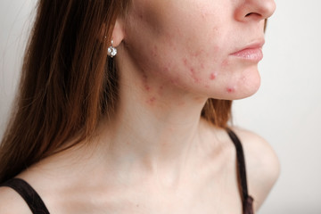 Woman with problem skin. Teen acne on young skin. Tools for removing acne.