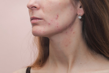 Woman with problem skin. Teen acne on young skin. Tools for removing acne.