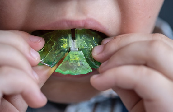 the boy inserts an orthodontic plate into his mouth to correct the malocclusion.green plastic orthodontic plate in the hands of a child
