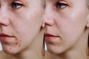 Young woman before and after acne treatment, closeup. Skin care concept