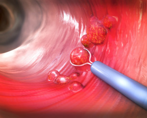 Removal of a colonic polyp with a electrical wire loop during a colonoscopy - 3d illustration - obrazy, fototapety, plakaty