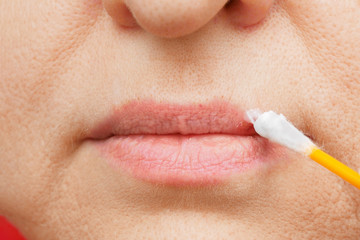 woman is treating herpes on lips by ointment, herpes blisters on female lips closeup	