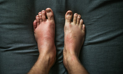 allergic reaction to the legs, swollen toes. angioedema