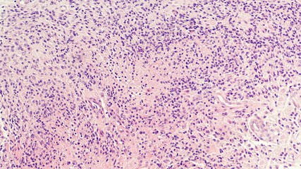 Microscopic image showing histology of a glioblastoma multiforme (GBM), a type of brain cancer.  Necrosis and vascular proliferation are diagnostic features of this high grade malignant tumor. 