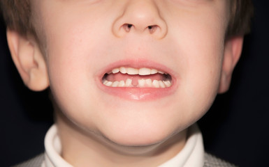 Fall out of the first tooth