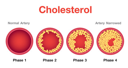 Cholesterol in artery, health risk , vector design