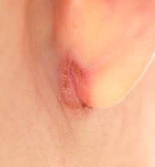 Fototapeta premium wound in the ear of a child