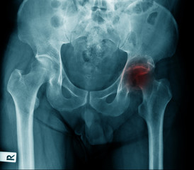 x-ray image of old woman show degenerative change of hip joint, hip avascular necrosis right side...