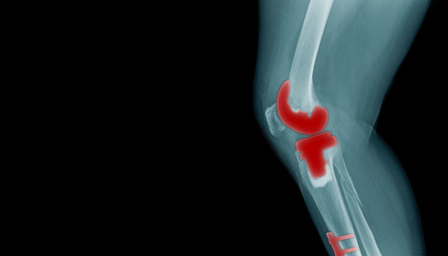 x-ray image of OA knee with banner design, TKA x-ray image