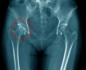 x-ray image of old woman show degenerative change of hip joint, hip avascular necrosis right side...