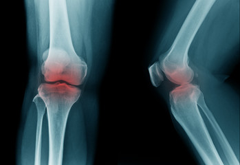 high quality x-ray knee joint of old man, OA knee of old man on black background in blue tone