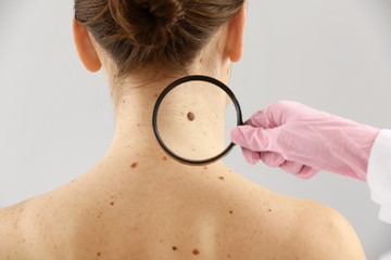Dermatologist examining moles of patient on light background