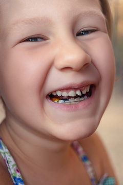 Little girl with orthodontics appliance and wobbly tooth