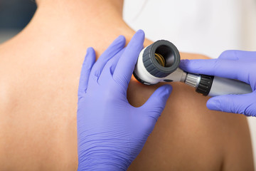 Doctor examining patient skin moles with dermoscope - obrazy, fototapety, plakaty