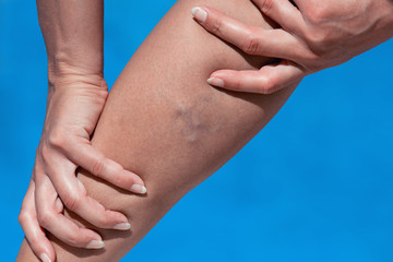Close-up of varicose veins on young female legs.
