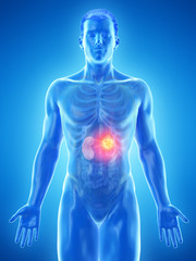 3d rendered medically accurate illustration of a mans kidneys tumor