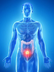 3d rendered medically accurate illustration of a mans colon tumor