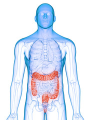 3d rendered medically accurate illustration of a diseased colon