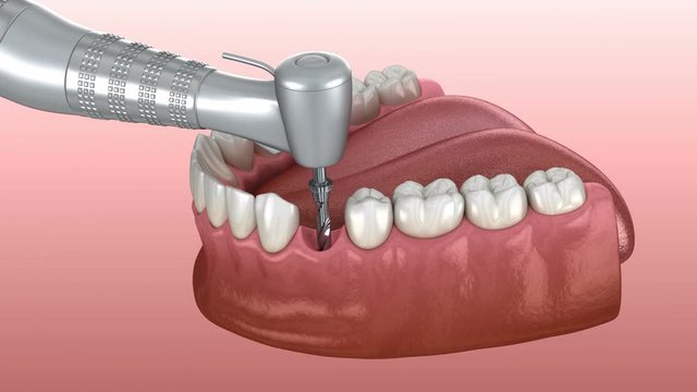 Implantation process in details: 3D animation of Drilling, implantat instalation, abutment and crown fixation