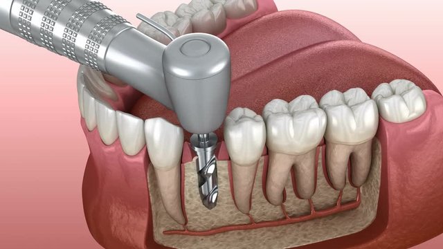 Implantation process in details: 3D animation of Drilling, implantat instalation, abutment and crown fixation