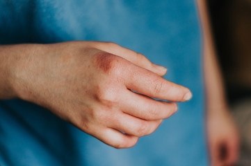Eczema in womans hands. Red allergy problem. Itchy arms