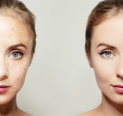 woman face portrait with clear and pimpled skin / skin treatment products concept for design