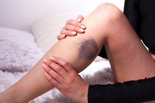 bruise from injury on the female leg